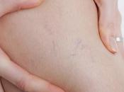 Jugos naturales para varices