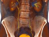 Duplicidad ureteral: ejemplo gráfico tomografía contraste