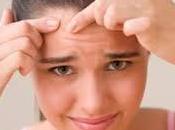 Remedios caseros para acné