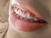 Soñar brackets ortodoncia puede indicar ciertos aspectos Descubrelos.