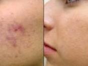 Curar cicatrices acné