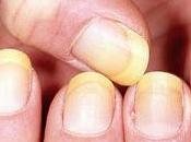 Cómo blanquear uñas amarillas!