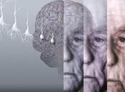 ¿Tener Artritis Reumatoide reduce riesgo desarrollar Alzheimer?