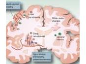 Microhemorragias cerebrales múltiples mixtas demencia pacientes factores riesgo vascular