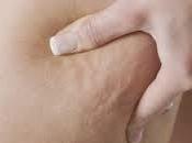 Remedios Naturales Contra Celulitis