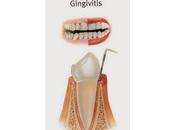 Como tratar gingivitis