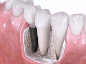 Implantes dentales cirugía: Pros Contras