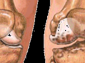 ¿Puede social ayudar paciente crónico osteomuscular?