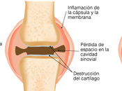 Síntomas consejos para tratamiento Artrosis