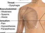 Grasa Problema Esclerosis Múltiple