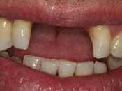 Pérdida dientes relacionado declive físico mental