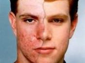 ¿Puede fármaco como Roacutan (para acné) provocar trastornos psiquiátricos suicidio?