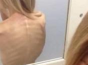 anorexia detendrá hasta mueras