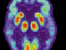 Mecanismo infeccioso detectado Alzheimer