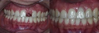 mitos verdades acerca implantes dentales