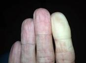 cómo dedo blanco trajo consigo nuevos diagnósticos