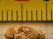 Cálculos litotricias