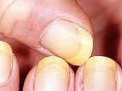 Descubre como eliminar hongos uñas manos facilmente
