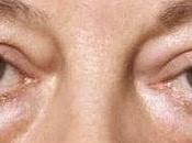 Remedios caseros contra bolsas ojos