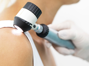 Encuesta: mayoría gente puede reconocer cáncer piel