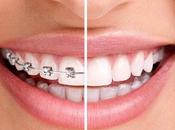 Ortodoncia Dental, Bracket: Preguntas respuestas comunes menos frecuentes)
