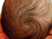 Fontanelas costra láctea