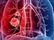 Fármaco experimental reduce difícil tumor pulmón