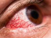 Conjuntivitis: cosas esenciales usted debe saber sobre ojos rosados