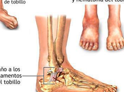 Esguince: aparte objetivo
