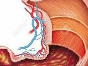 Gastritis