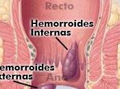 ¿Qué hemorroides?