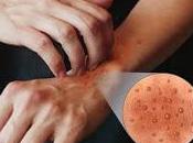 Dermatitis manos: cómo solucionar este problema frecuente invalidante
