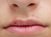 Remedios caseros para combatir herpes labial