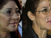 botox Cilia Flores