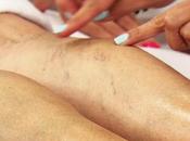 remedios caseros para eliminar varices arañitas piernas: