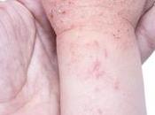 Cómo controlar dermatitis atópica hijo invierno