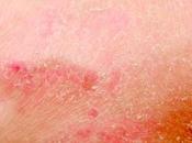 ¿Cuáles causas comunes peladura piel pene?