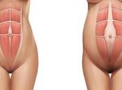 abdominales tras parto afectan diástasis abdominal