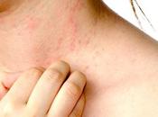 Urticaria (urticaria angioedema)