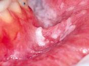 Peeling revestimiento mucosa oral