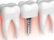 molesto tratamiento implante dental?