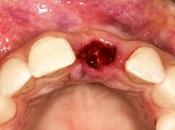 alveolitis seca complicación dolorosa extracción diente