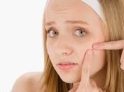 tips remedios caseros para evitar acné