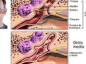 Cómo prevenir otitis verano