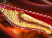 Hipercolesterolemia: Elevado nivel colesterol