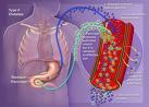 Cirugia Metabolica Cura Diabetes