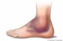Elimine hematomas