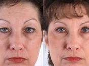 Blefaroplastia, recupera mirada