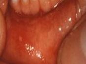 Homeopatía casos Muguet hongos boca bebé