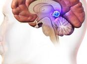 ¿Qué quiste pineal?